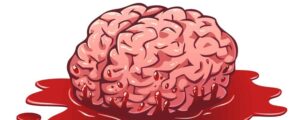 Xuất huyết não là gì? Nguyên nhân, triệu chứng và điều trị