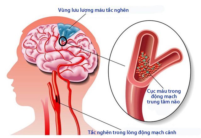 Tai biến mạch máu não nhẹ: Đừng chủ quan