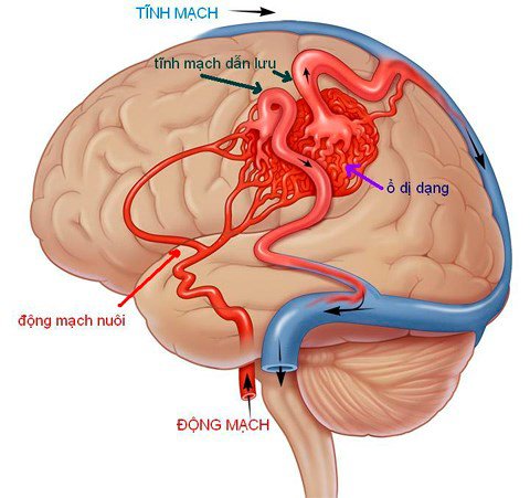 Dị dạng mạch máu não