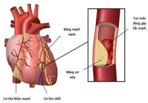 Tầm soát sớm bệnh tim mạch tránh nguy cơ đột quỵ