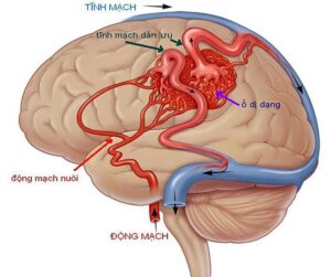 dị dạng mạch máu đầu