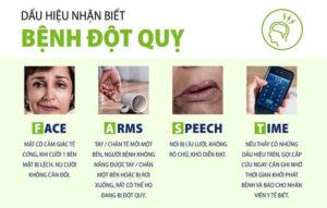 đột quỵ não