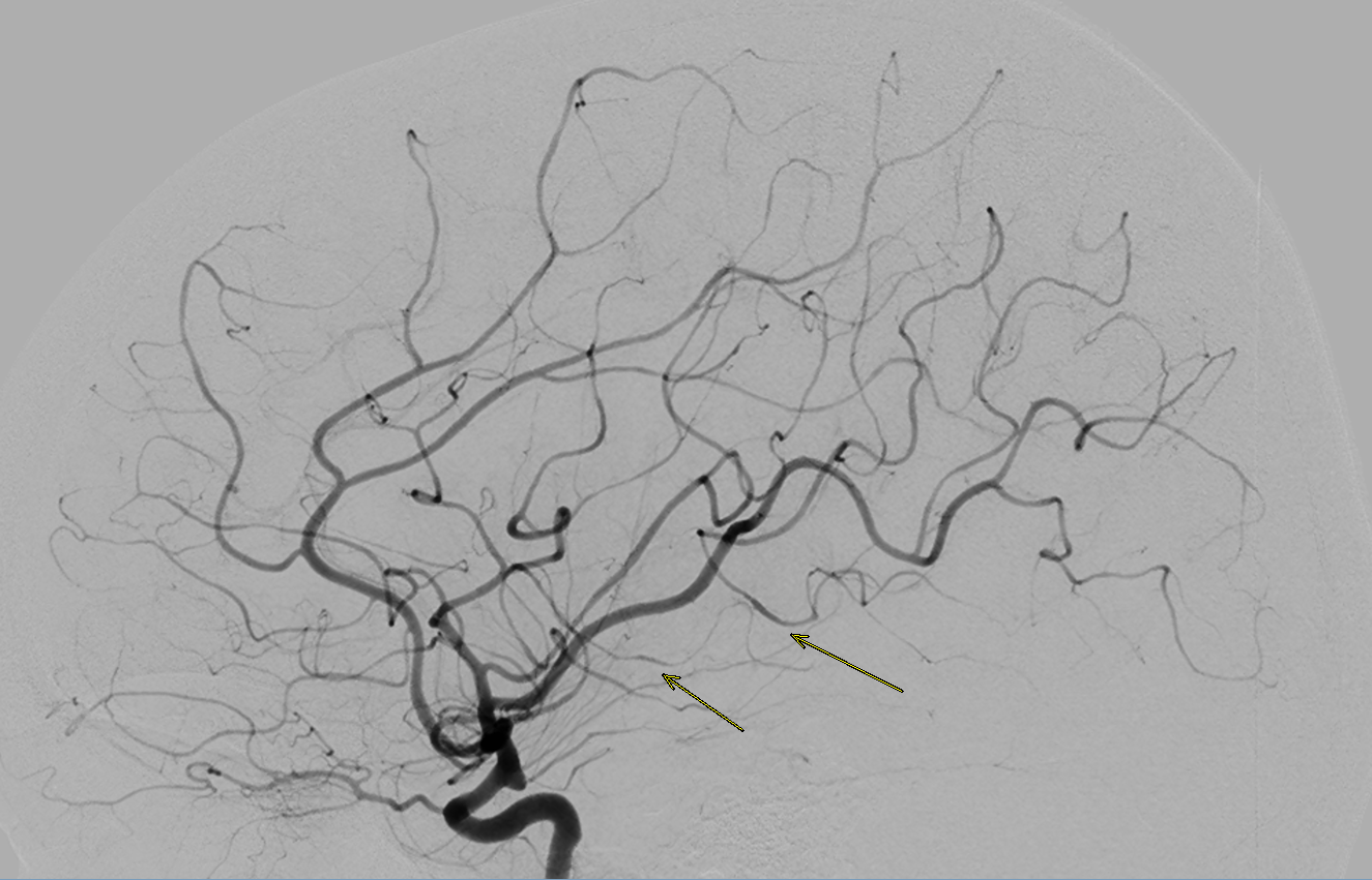 Hình ảnh chụp mạch máu não (DSA) của bệnh nhân nữ 42 tuổi bị nhồi máu não nhiều bên