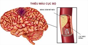 Thiếu máu não cục bộ