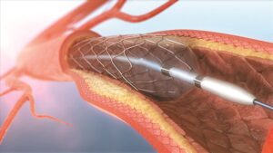 đặt stent mạch vành