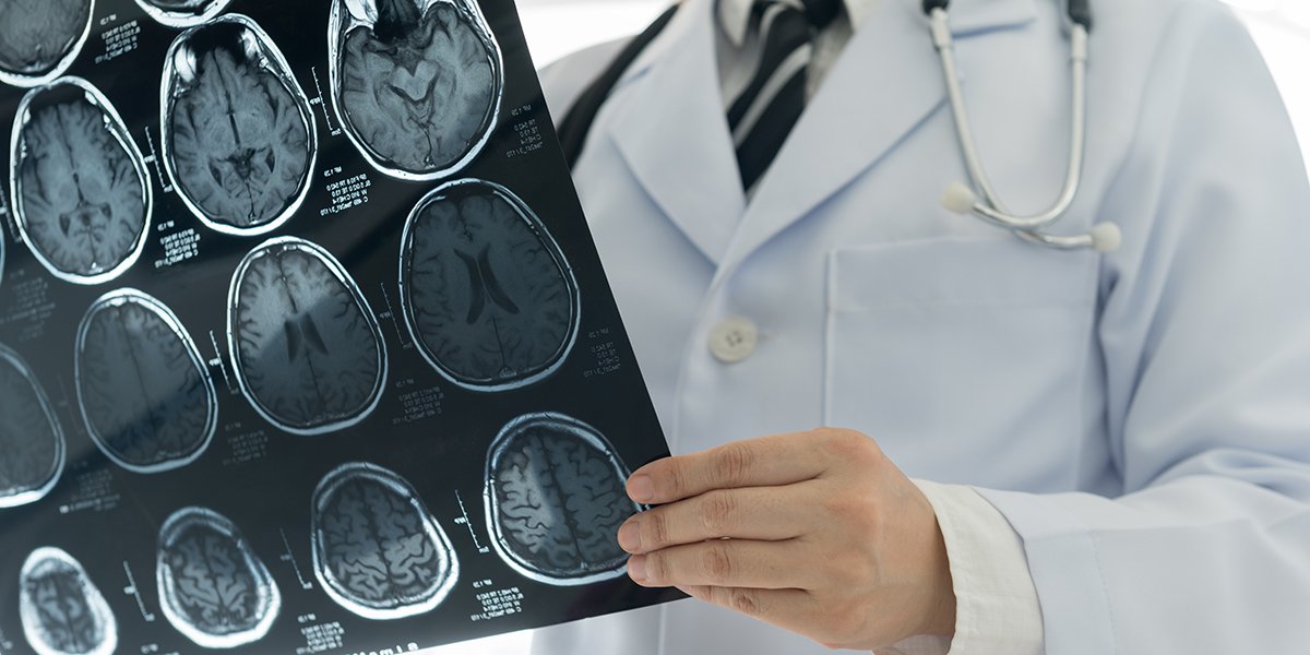 CT-scanner não có thể giúp bác sĩ chẩn đoán đột quỵ