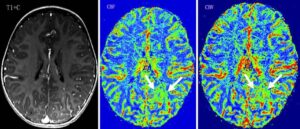 CT scan tưới máu não