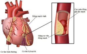 Nhồi máu cơ tim ở người trẻ ngày càng gia tăng