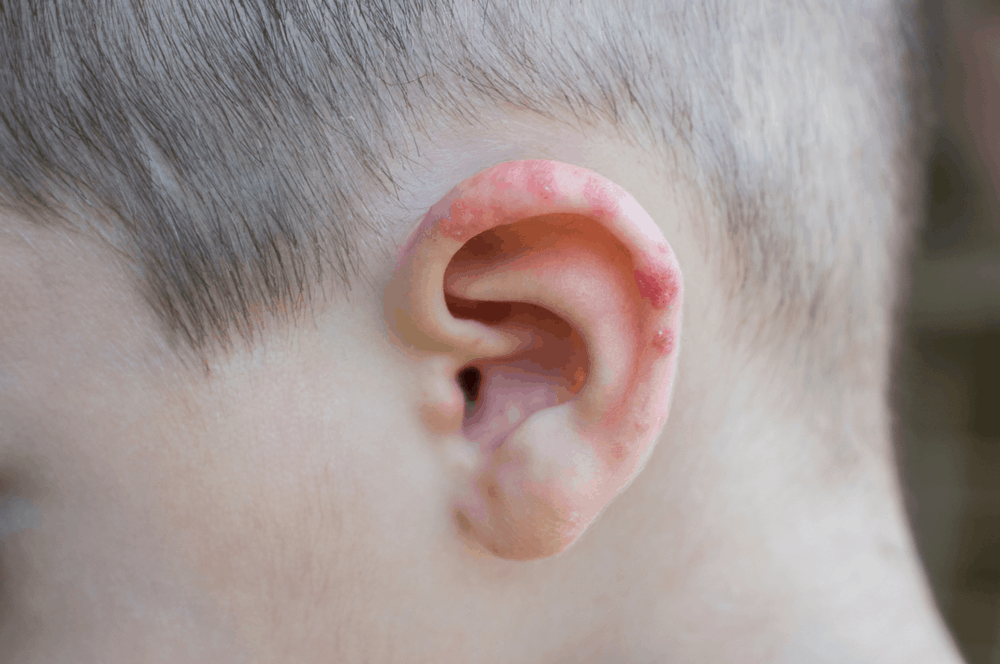 bệnh zona trong tai