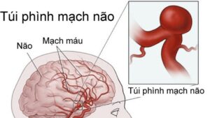 phình mạch máu não