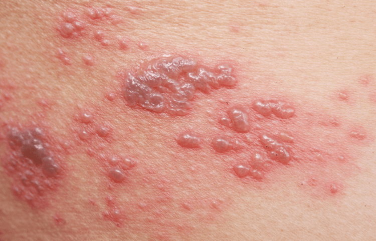mụn nước trên da là dấu hiệu của bệnh zona