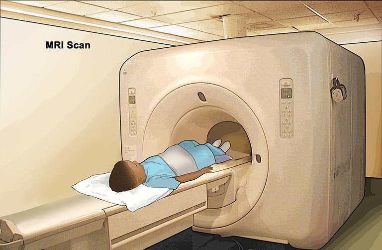 Chụp MRI giúp bác sĩ chẩn đoán đột quỵ não ở trẻ em