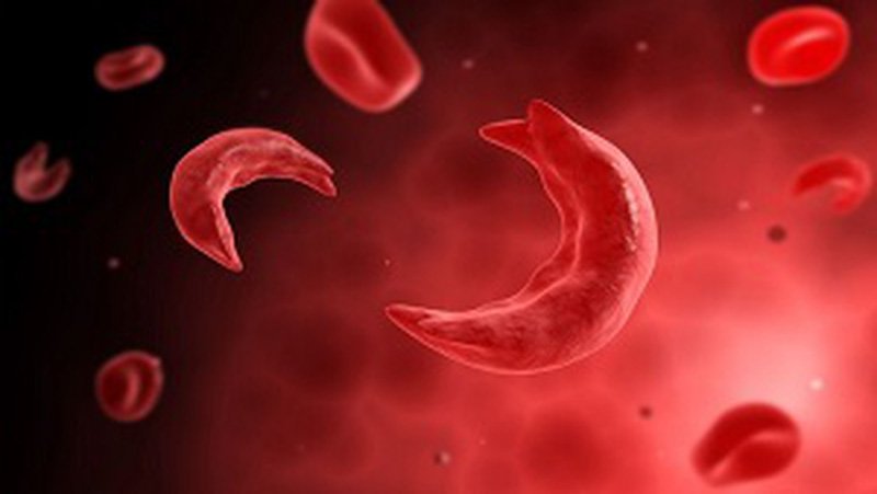 Bệnh hồng cầu hình liềm gây thiếu máu cục bộ ở trẻ nhỏ