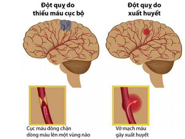 Hình thành cục máu đông trong não: Nguyên nhân hàng đầu gây đột quỵ