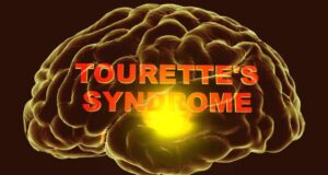 Hội chứng Tourette