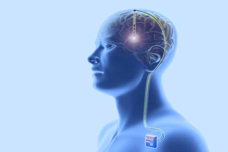 Kỹ thuật kích thích não sâu gồm 3 thiết bị cấy ghép: điện cực, dây dẫn và máy phát xung điện