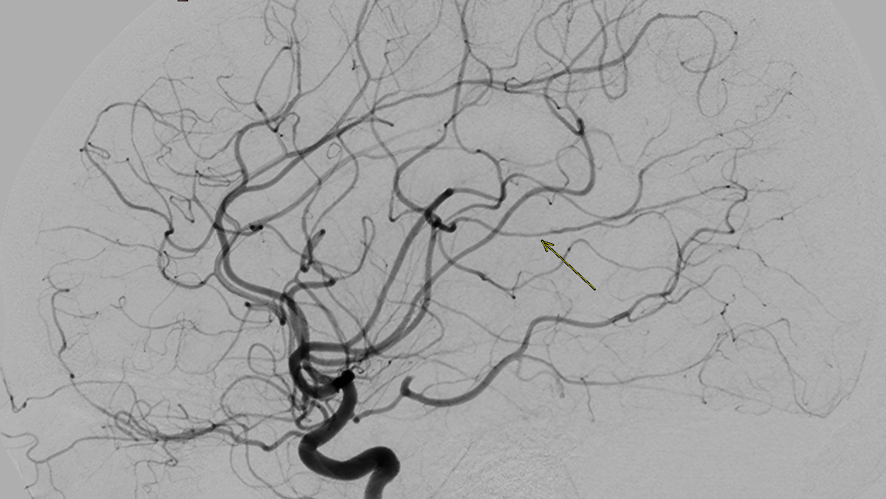 Hình ảnh chụp mạch máu não (DSA) của bệnh nhân nữ 42 tuổi bị nhồi máu não nhiều bên
